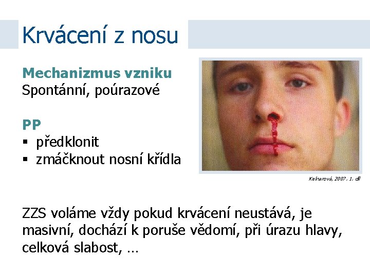 Krvácení z nosu Mechanizmus vzniku Spontánní, poúrazové PP předklonit zmáčknout nosní křídla Kelnarová, 2007.