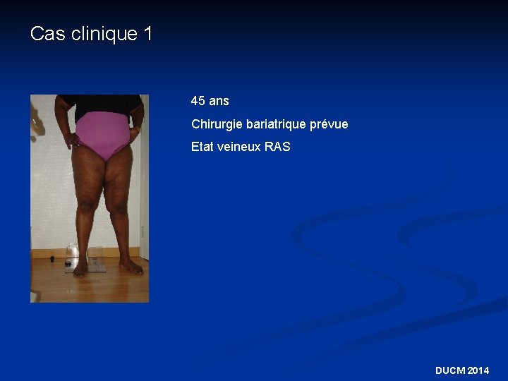 Cas clinique 1 45 ans Chirurgie bariatrique prévue Etat veineux RAS DUCM 2014 