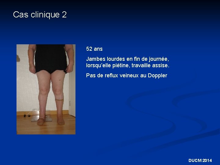 Cas clinique 2 52 ans Jambes lourdes en fin de journée, lorsqu’elle piétine, travaille