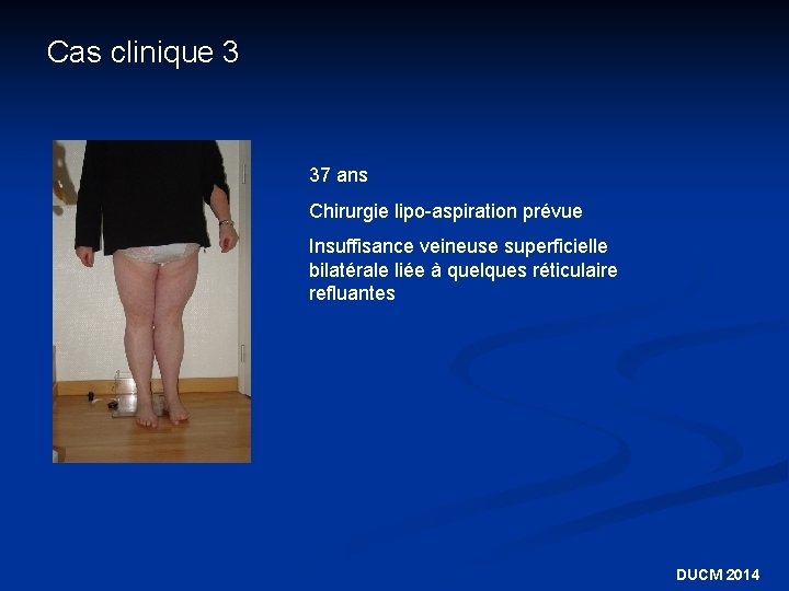 Cas clinique 3 37 ans Chirurgie lipo-aspiration prévue Insuffisance veineuse superficielle bilatérale liée à