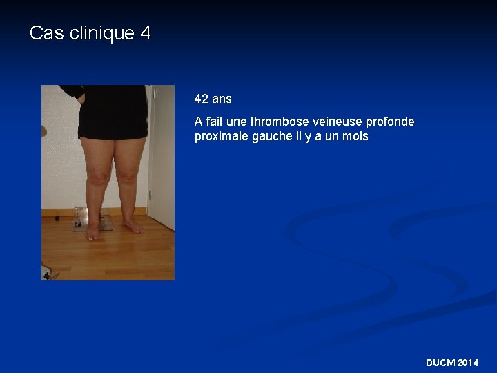Cas clinique 4 42 ans A fait une thrombose veineuse profonde proximale gauche il