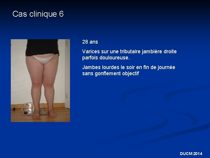 Cas clinique 6 28 ans Varices sur une tributaire jambière droite parfois douloureuse. Jambes