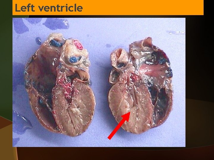 Left ventricle 