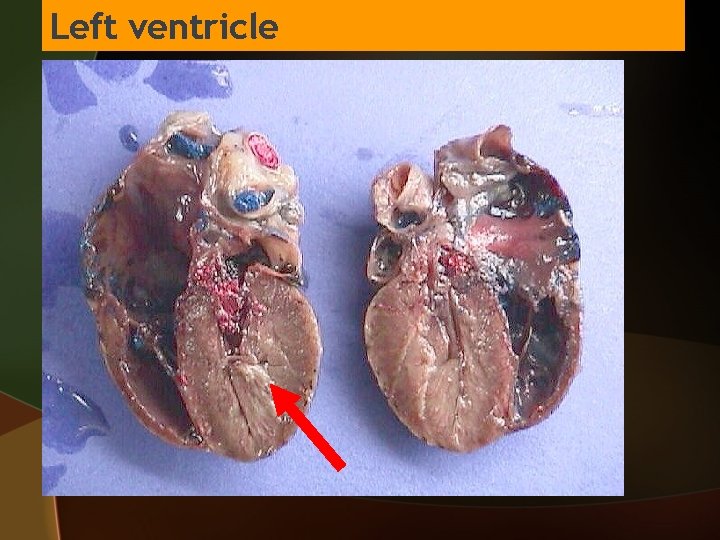 Left ventricle 