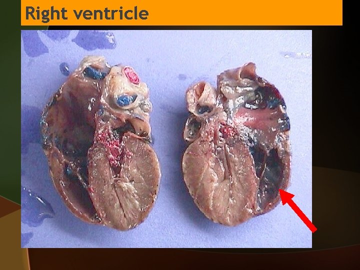 Right ventricle 