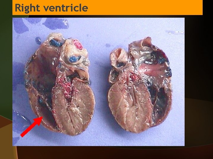 Right ventricle 