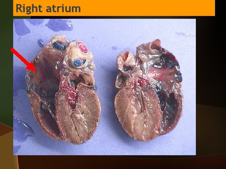 Right atrium 