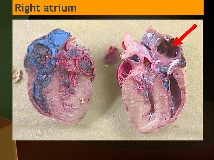 Right atrium 