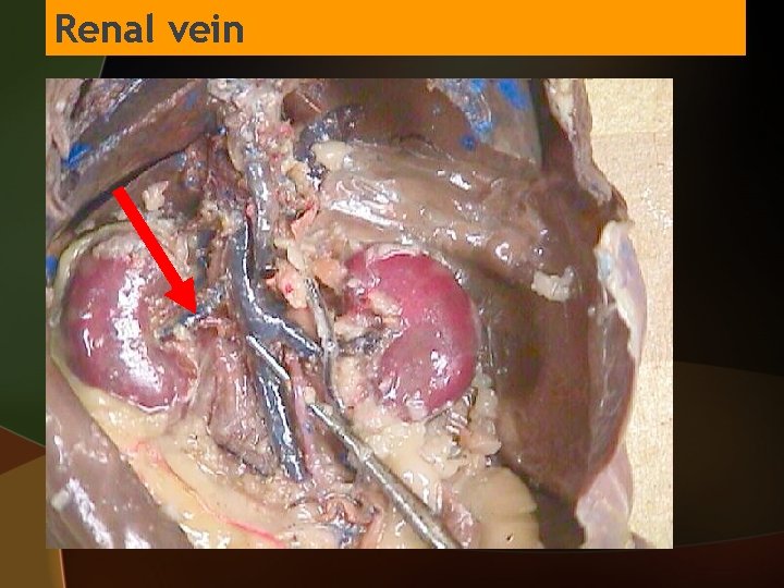 Renal vein 