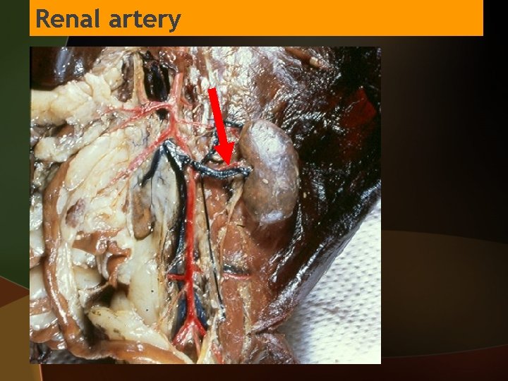 Renal artery 