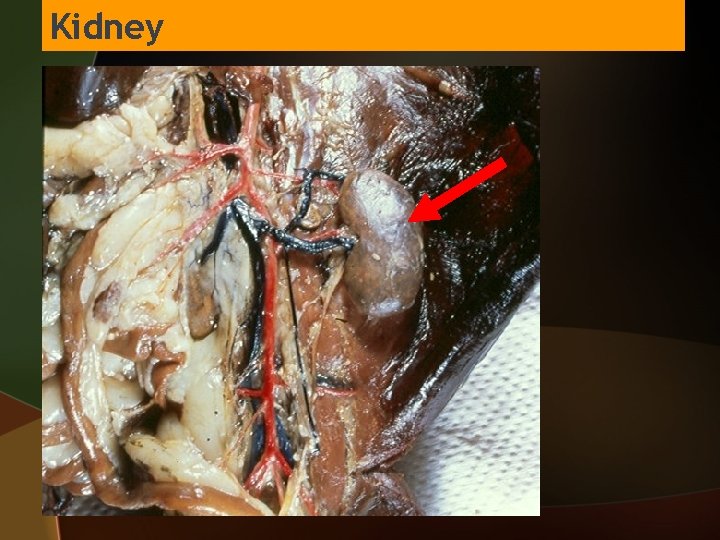 Kidney 