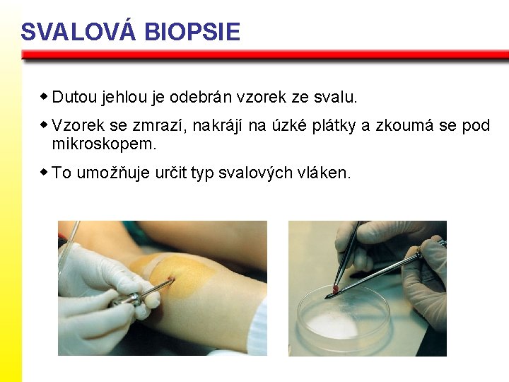 SVALOVÁ BIOPSIE w Dutou jehlou je odebrán vzorek ze svalu. w Vzorek se zmrazí,