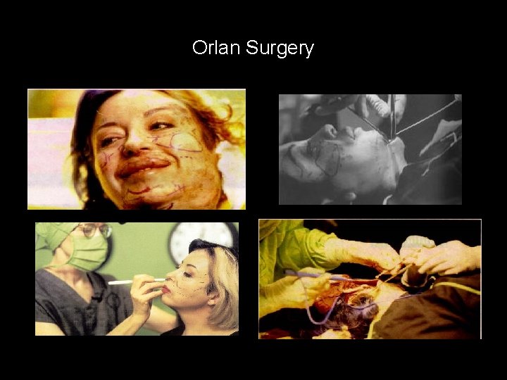 Orlan Surgery 