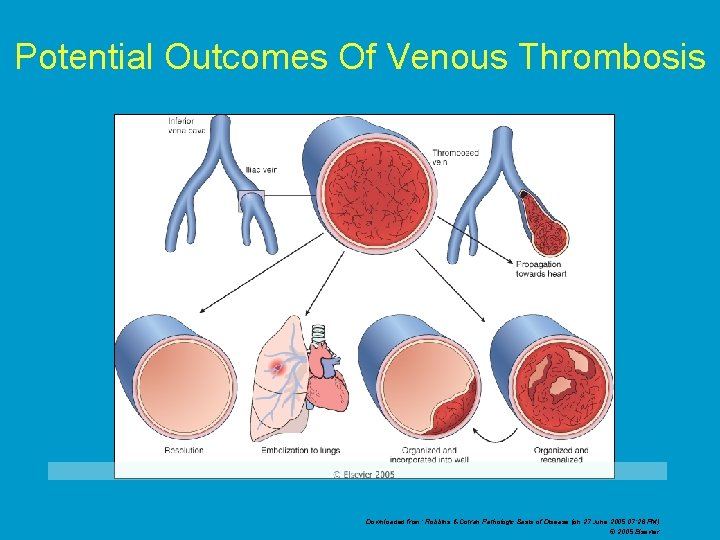 Potential Outcomes Of Venous Thrombosis Downloaded from: Robbins & Cotran Pathologic Basis of Disease