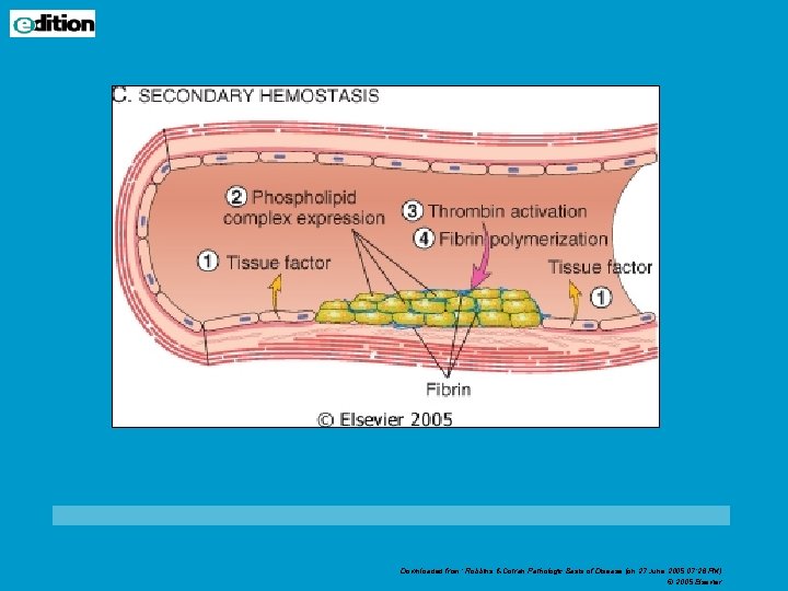 Downloaded from: Robbins & Cotran Pathologic Basis of Disease (on 27 June 2005 07: