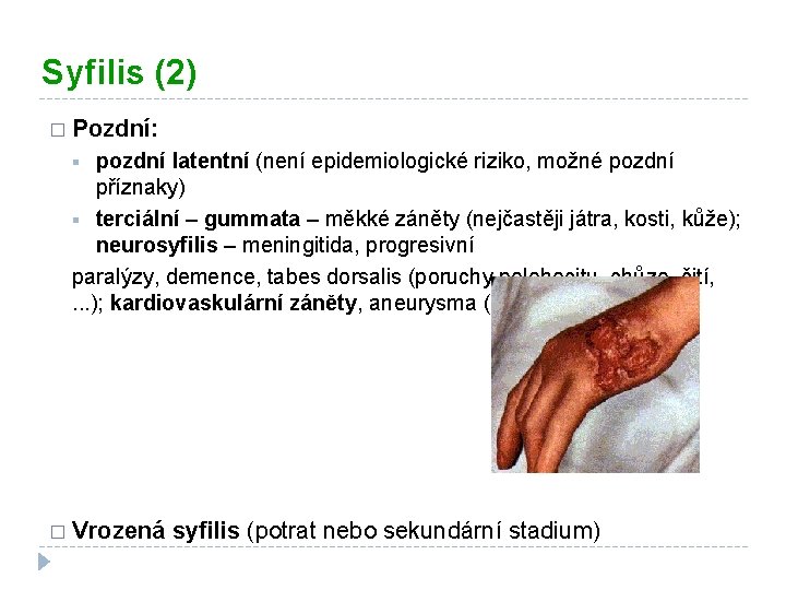 Syfilis (2) � Pozdní: pozdní latentní (není epidemiologické riziko, možné pozdní příznaky) § terciální