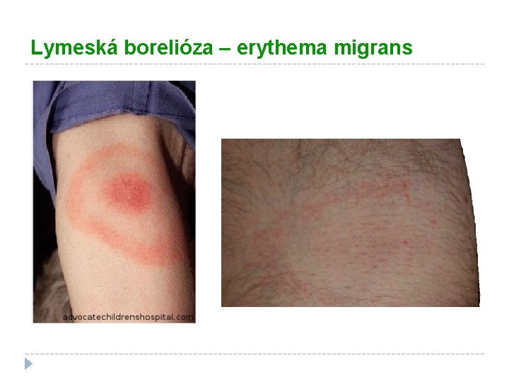 Lymeská borelióza – erythema migrans 