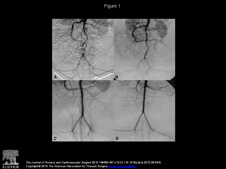 Figure 1 The Journal of Thoracic and Cardiovascular Surgery 2013 146400 -407. e 1