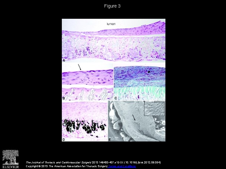 Figure 3 The Journal of Thoracic and Cardiovascular Surgery 2013 146400 -407. e 1