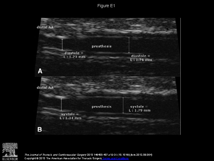 Figure E 1 The Journal of Thoracic and Cardiovascular Surgery 2013 146400 -407. e