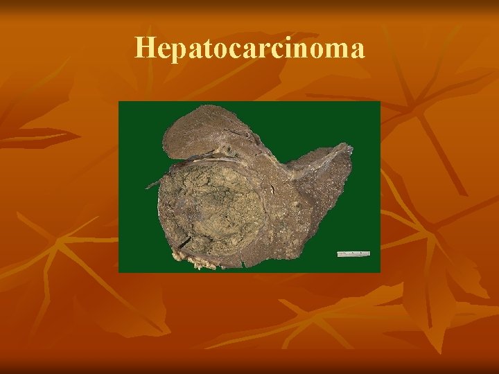 Hepatocarcinoma 