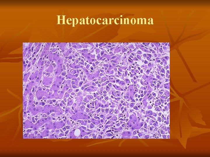 Hepatocarcinoma 