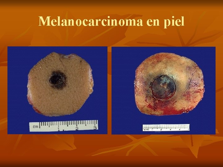Melanocarcinoma en piel 