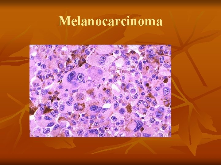 Melanocarcinoma 