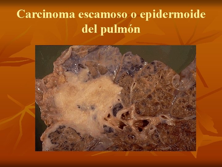 Carcinoma escamoso o epidermoide del pulmón 