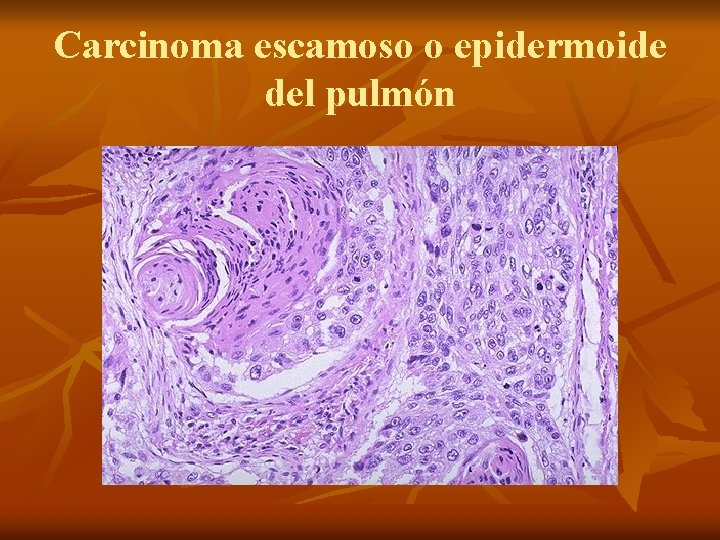 Carcinoma escamoso o epidermoide del pulmón 