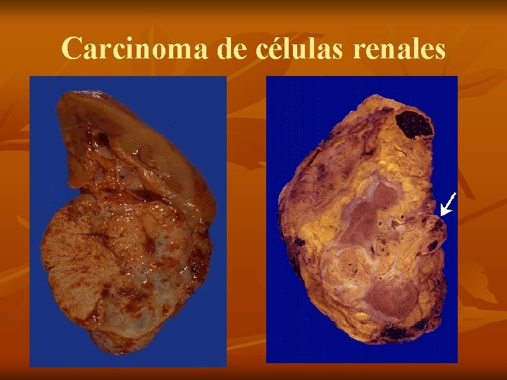 Carcinoma de células renales 