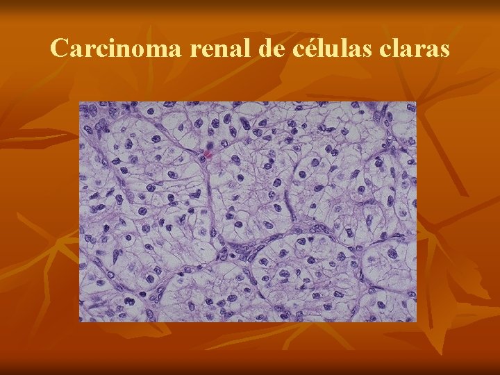 Carcinoma renal de células claras 