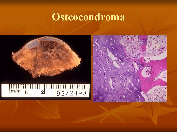 Osteocondroma 