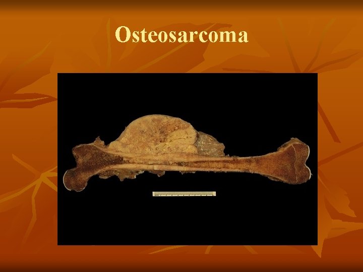 Osteosarcoma 