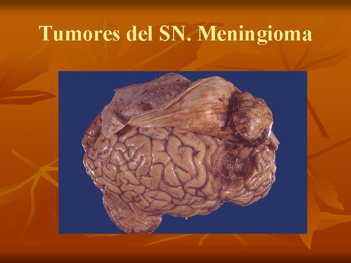 Tumores del SN. Meningioma 