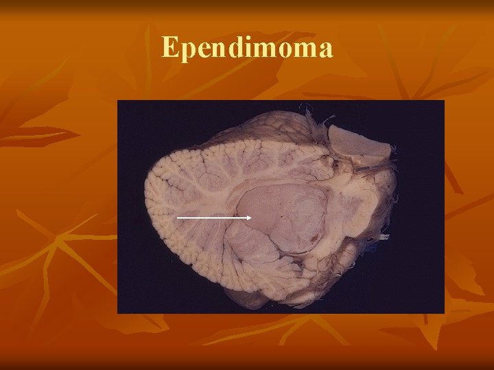 Ependimoma 