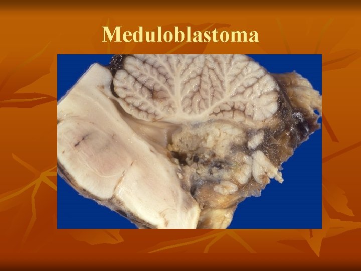 Meduloblastoma 