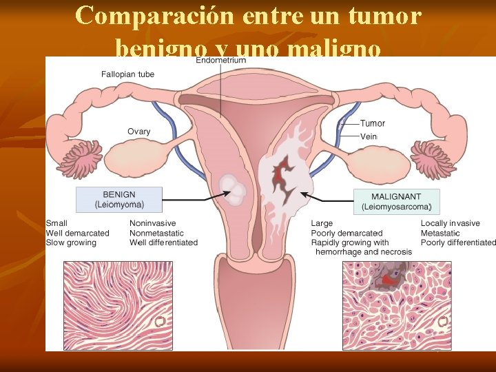 Comparación entre un tumor benigno y uno maligno 
