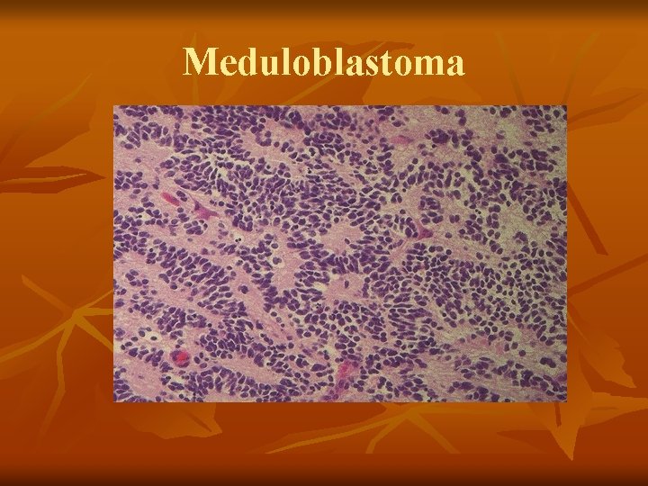 Meduloblastoma 