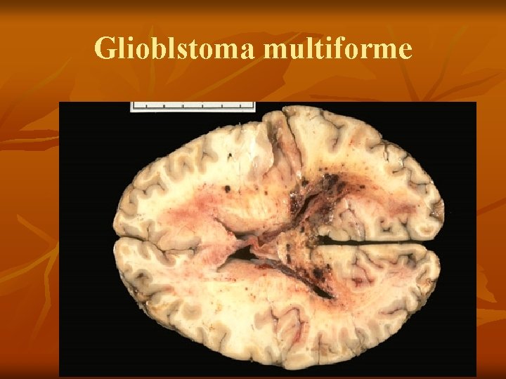 Glioblstoma multiforme 