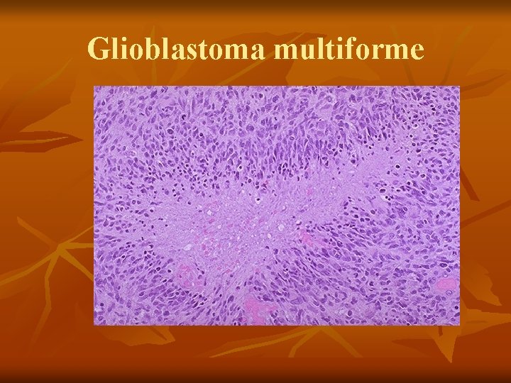 Glioblastoma multiforme 