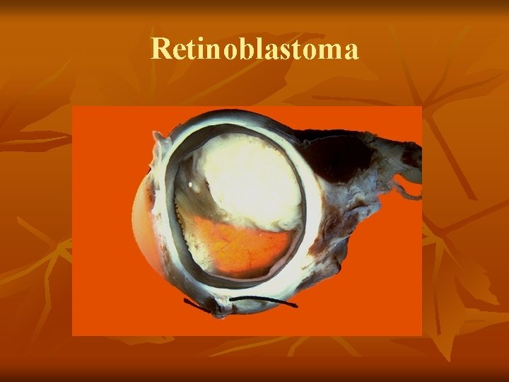 Retinoblastoma 