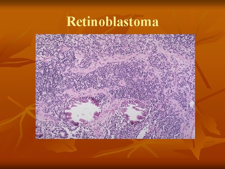 Retinoblastoma 