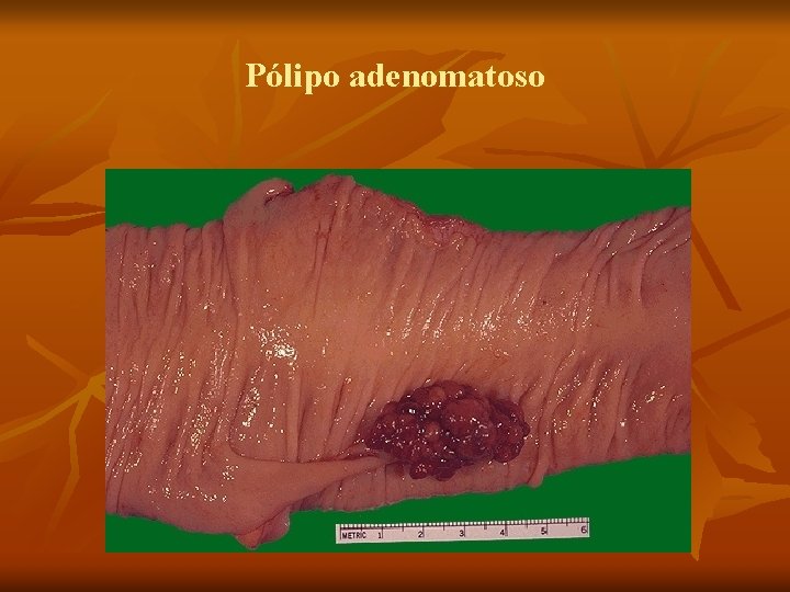 Pólipo adenomatoso 