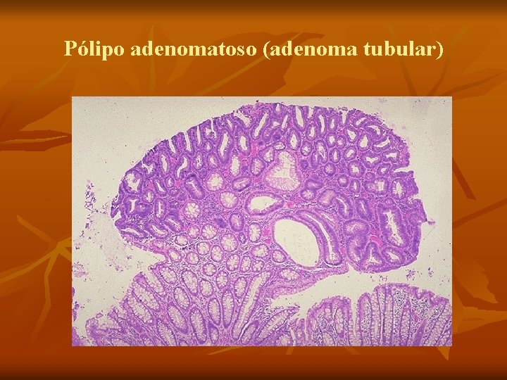 Pólipo adenomatoso (adenoma tubular) 