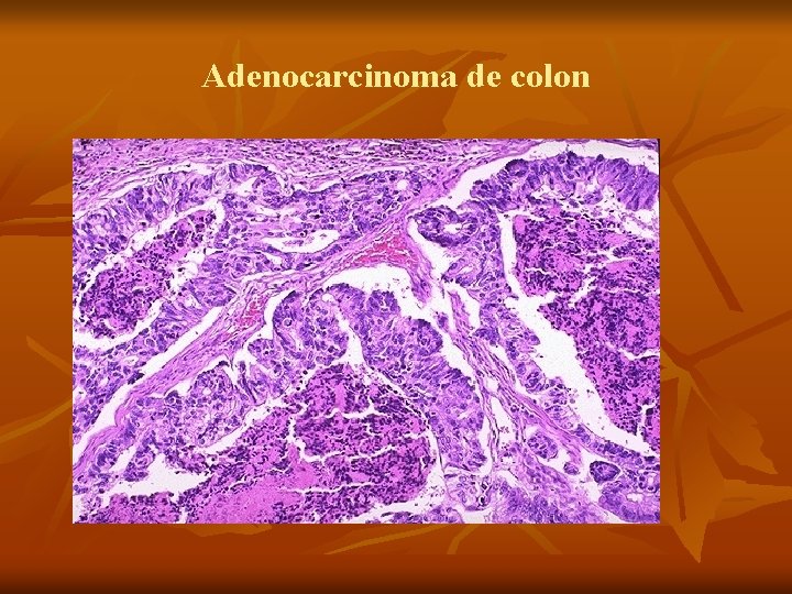 Adenocarcinoma de colon 
