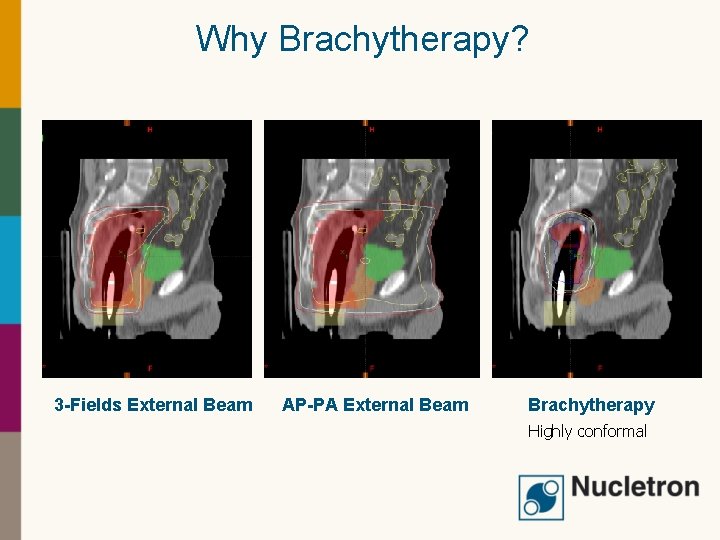 Why Brachytherapy? 3 -Fields External Beam AP-PA External Beam Brachytherapy Highly conformal 