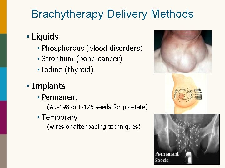 Brachytherapy Delivery Methods Liquids Phosphorous (blood disorders) Strontium (bone cancer) Iodine (thyroid) Implants Permanent