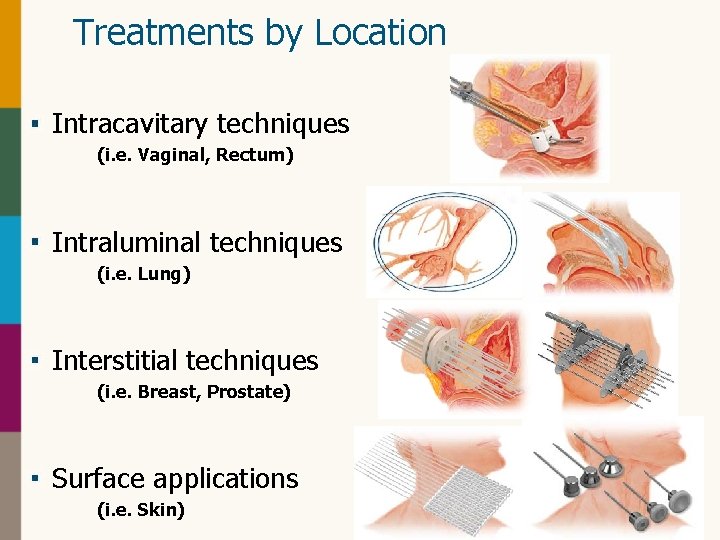 Treatments by Location Intracavitary techniques (i. e. Vaginal, Rectum) Intraluminal techniques (i. e. Lung)