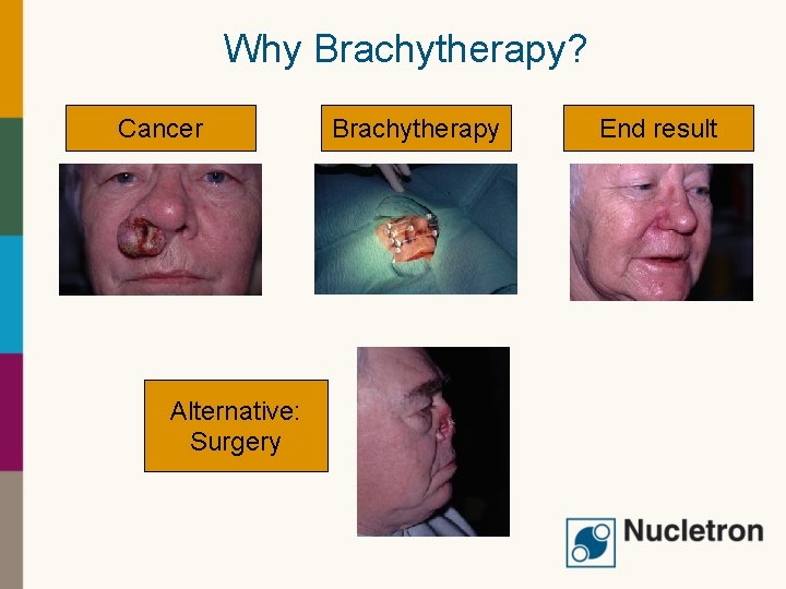Why Brachytherapy? Cancer Alternative: Surgery Brachytherapy End result 